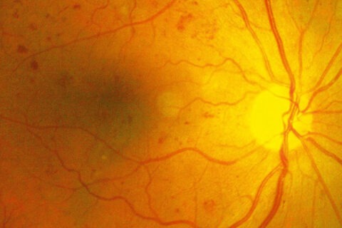 Diabetic Retinopathy