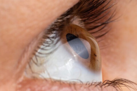 Keratoconus Treatment